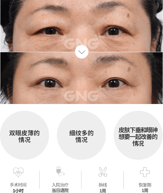 童颜眼整形,上眼睑,下眼睑- 韩国GNG医院整形外科耳鼻喉科