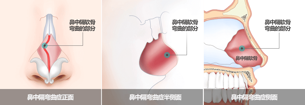 鼻中隔弯曲症, 鼻中隔矫正术- 韩国GNG医院整形外科耳鼻喉科