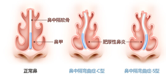 鼻中隔弯曲症, 鼻中隔矫正术- 韩国GNG医院整形外科耳鼻喉科