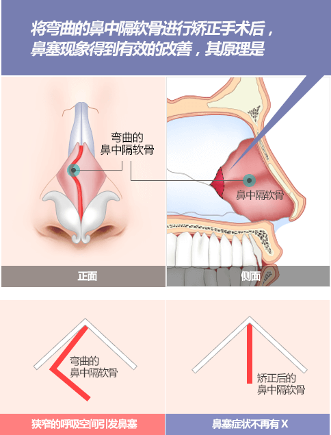 鼻中隔弯曲症, 鼻中隔矫正术- 韩国GNG医院整形外科耳鼻喉科