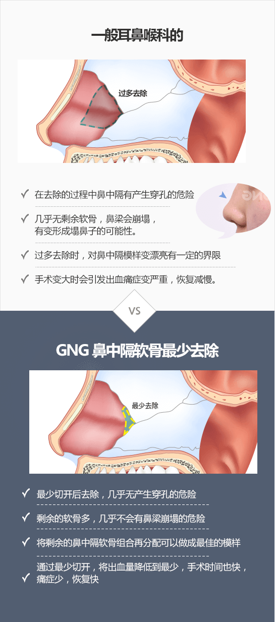 鼻中隔弯曲症, 鼻中隔矫正术- 韩国GNG医院整形外科耳鼻喉科