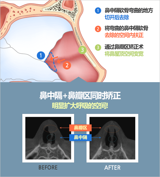 鼻中隔弯曲症, 鼻中隔矫正术- 韩国GNG医院整形外科耳鼻喉科